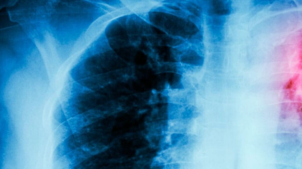 Confirman menor con tuberculosis en colegio de Biobío